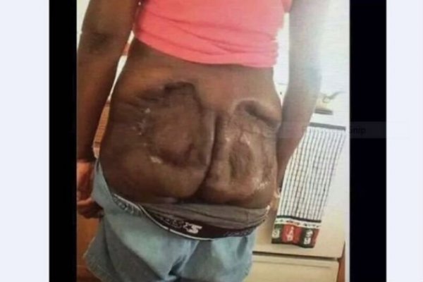 Butt-implants